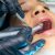 Dentist fillings